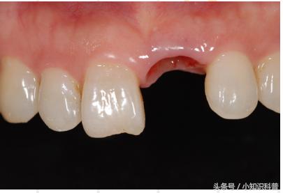 烤瓷牙中间缺牙可以做活动假牙吗,多颗牙缺失做烤瓷牙还是种植牙好