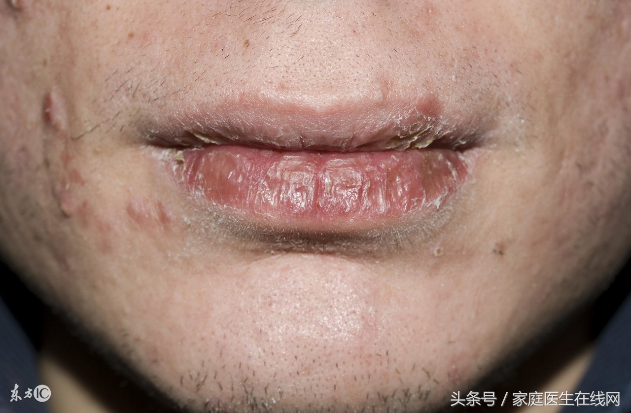 唇炎怎么办及注意事项 (唇炎该怎么忌口)