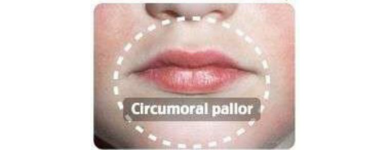 猩红热夏季,猩红热要保暖吗