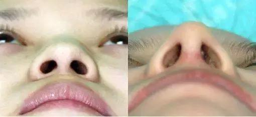 假体隆鼻都有什么术式,假体隆鼻一般用什么材料