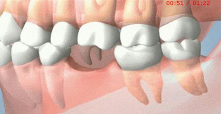 烤瓷牙中间缺牙可以做活动假牙吗,多颗牙缺失做烤瓷牙还是种植牙好