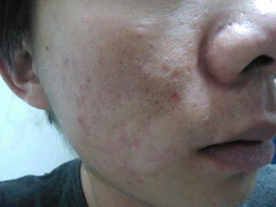 毛孔粗大做深层清洁能改善吗,毛孔粗大深层清洁用什么牌子面膜