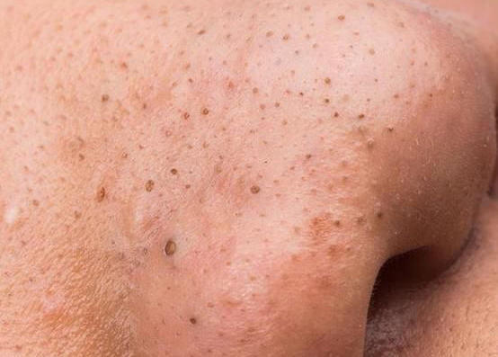 毛孔粗大做深层清洁能改善吗,毛孔粗大深层清洁用什么牌子面膜