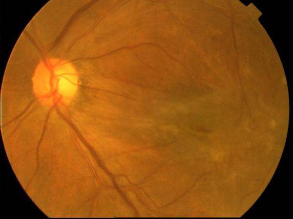 黄斑病变的克星,得了黄斑病变需要忌什么食物