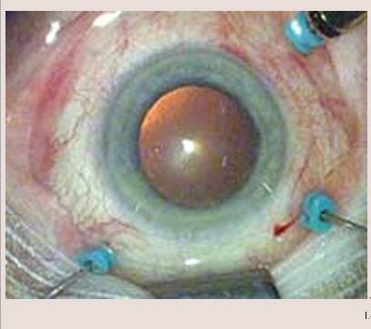 黄斑病变的克星,得了黄斑病变需要忌什么食物