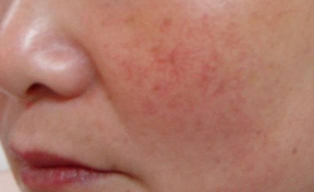 秋天嘴皮干燥起皮什么原因,秋天皮肤干燥起皮用什么护肤品