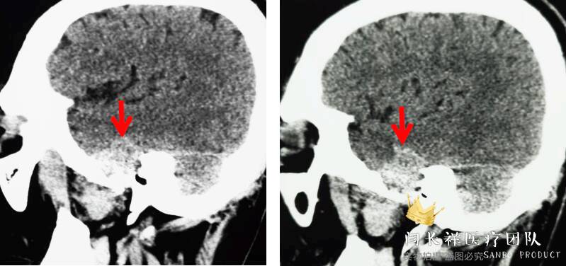 烦人的耳鸣,烦人耳鸣
