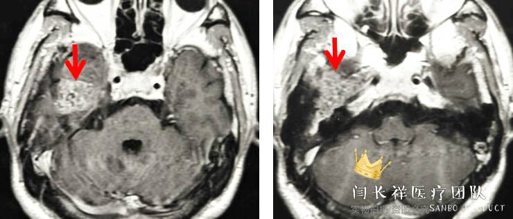烦人的耳鸣,烦人耳鸣