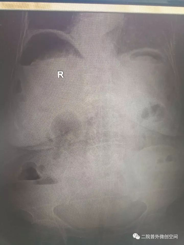 「病人故事」耄耋胃穿孔老人经微创手术治疗后今天痊愈出院啦!这个疾病很凶险,常吃止痛药的朋友要注意哦!