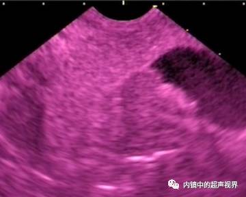 超声内镜美图攻略——动态范围与伪彩