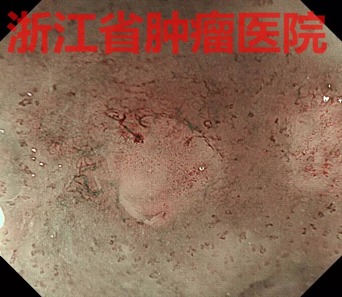 食管大面积黏膜病变,看看这家医院如何处理?!