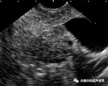 超声内镜美图攻略——动态范围与伪彩