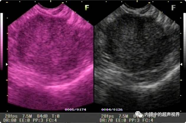 超声内镜美图攻略——动态范围与伪彩