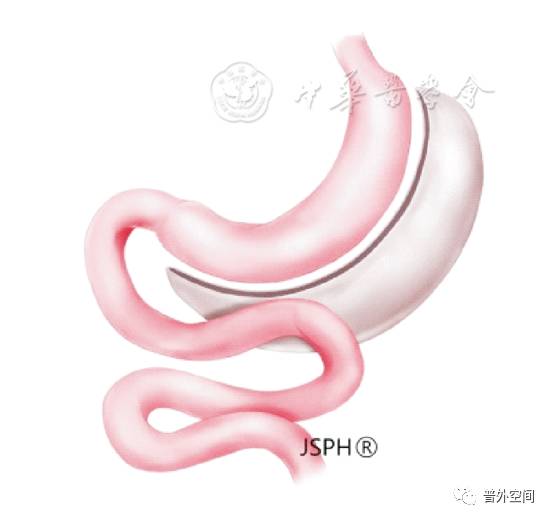 减重代谢手术哪里做的最好,减重手术治疗代谢疾病的原理