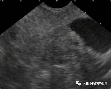 超声内镜美图攻略——动态范围与伪彩