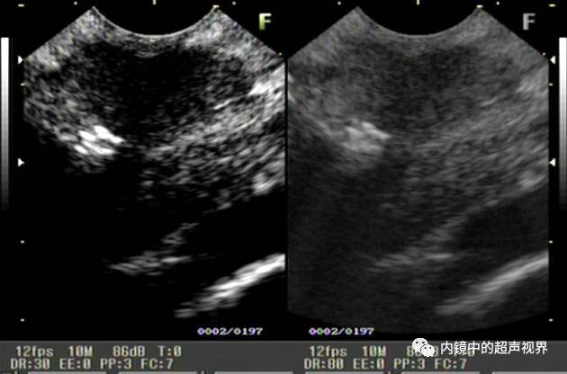 超声内镜美图攻略——动态范围与伪彩