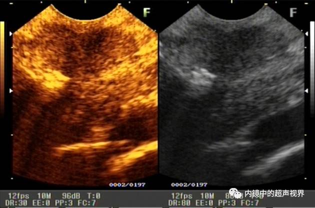 超声内镜美图攻略——动态范围与伪彩