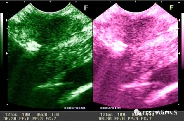 超声内镜美图攻略——动态范围与伪彩