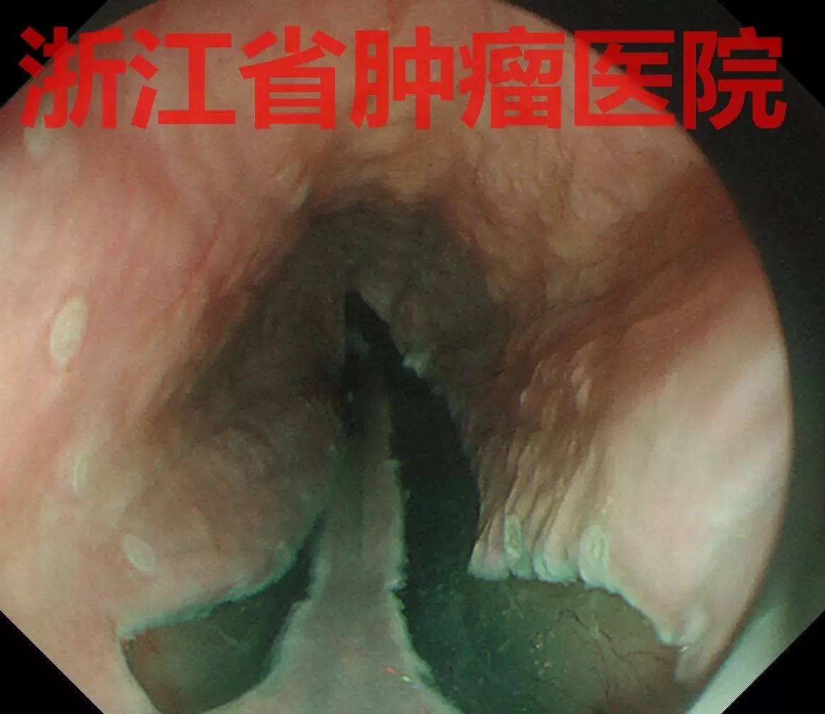 食管大面积黏膜病变,看看这家医院如何处理?!