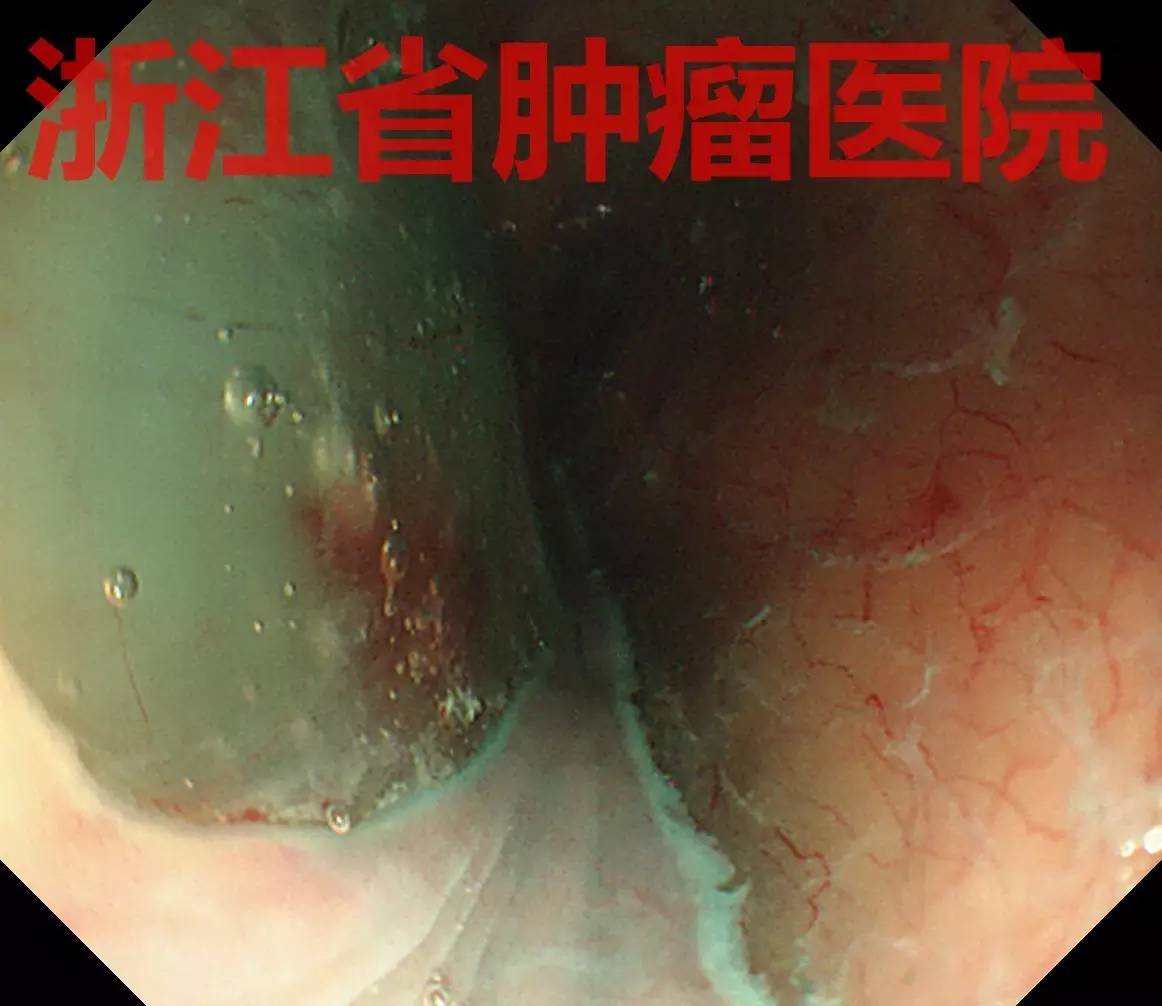 食管大面积黏膜病变，看看这家医院如何处理？！