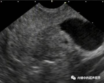 超声内镜美图攻略——动态范围与伪彩