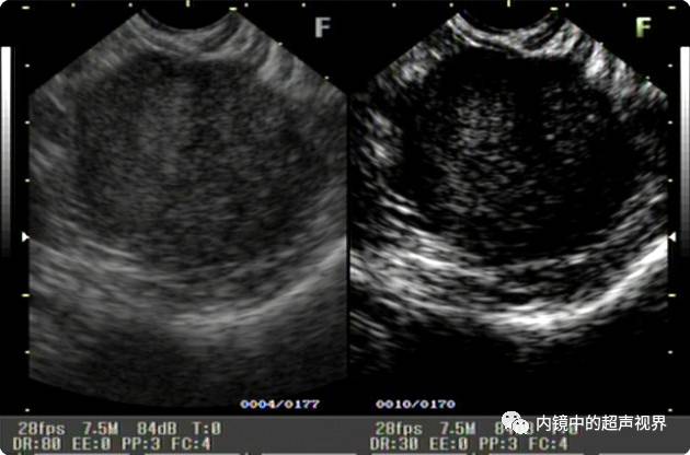 超声内镜美图攻略——动态范围与伪彩
