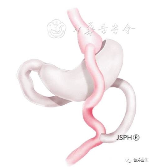 减重代谢手术哪里做的最好,减重手术治疗代谢疾病的原理