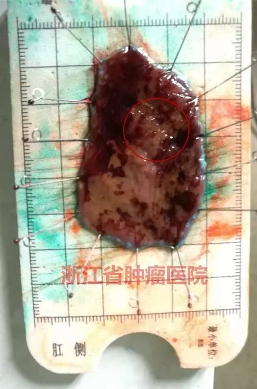 食管大面积黏膜病变,看看这家医院如何处理?!