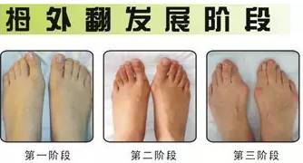 大脚趾外翻的自我改善,大脚趾外翻怎么矫正锻炼