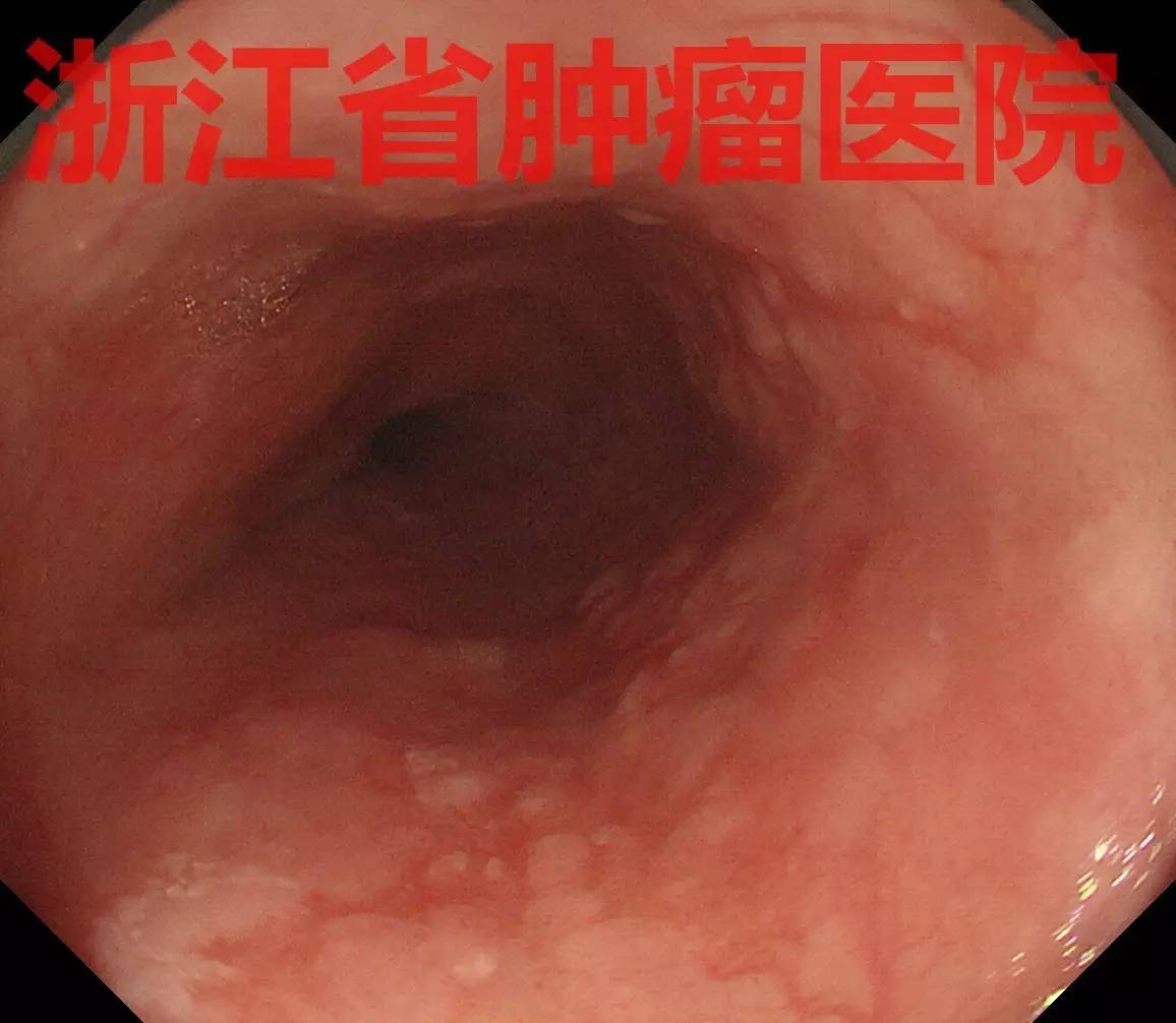 食管大面积黏膜病变,看看这家医院如何处理?!