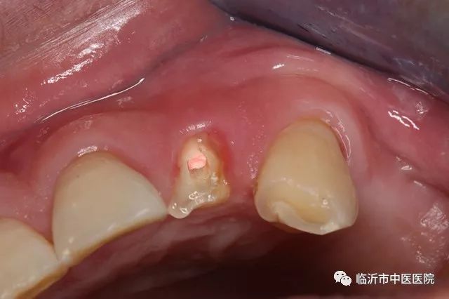 北京口腔医院可以接断牙吗,牙科断牙怎么补救