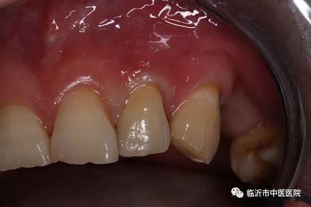 北京口腔医院可以接断牙吗,牙科断牙怎么补救