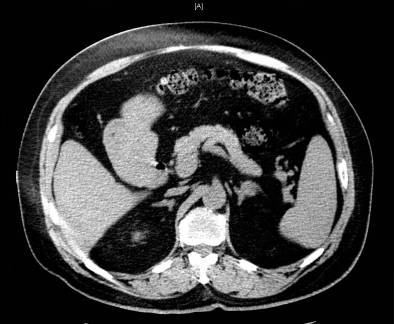 高血压病历的鉴别诊断,高血压合并症怎么检查