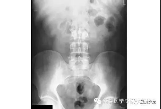 详细腹部平片解剖+正常表现+读片技巧+病例分析
