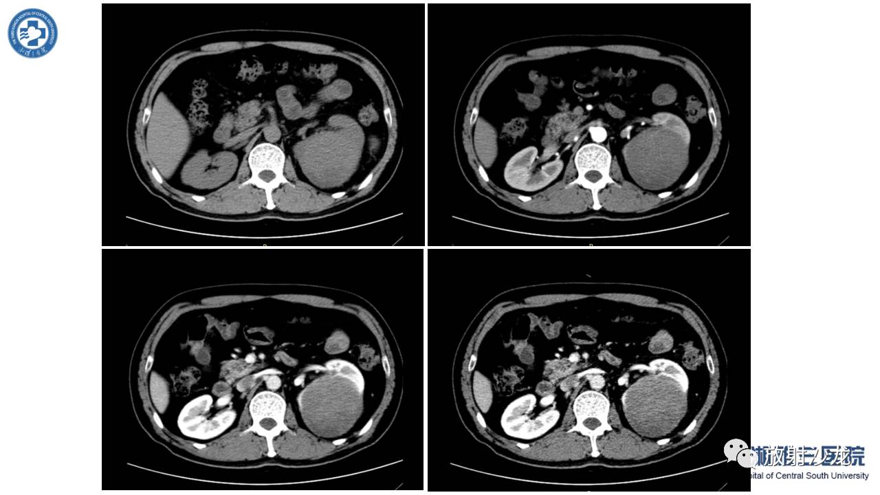 「每日一例｜489例」男，左侧腰部撞伤后疼痛3月