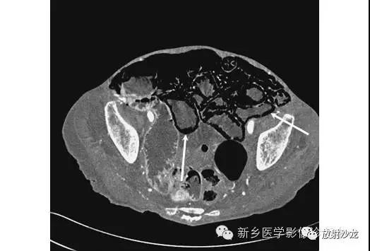 详细腹部平片解剖+正常表现+读片技巧+病例分析