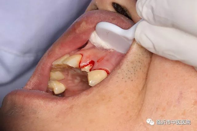 北京口腔医院可以接断牙吗,牙科断牙怎么补救