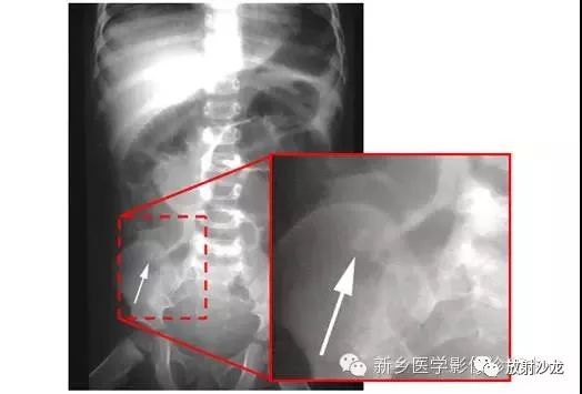 详细腹部平片解剖+正常表现+读片技巧+病例分析
