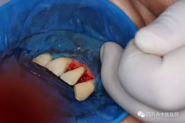 北京口腔医院可以接断牙吗,牙科断牙怎么补救