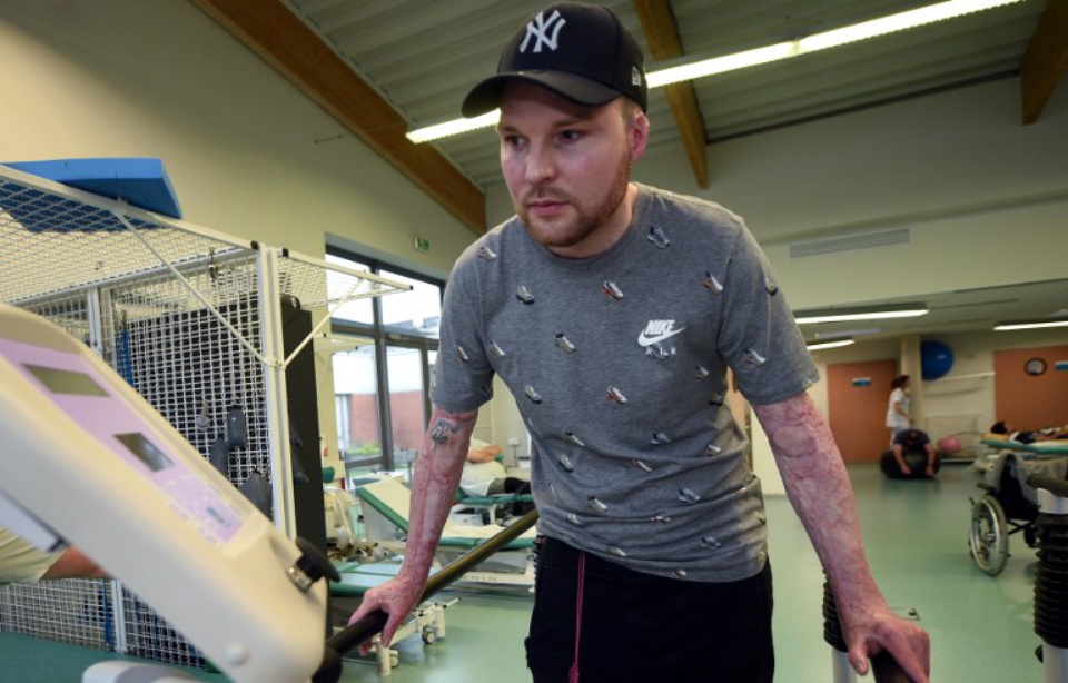 法国完成首例“全身换皮”手术严重烧伤男子起死回生