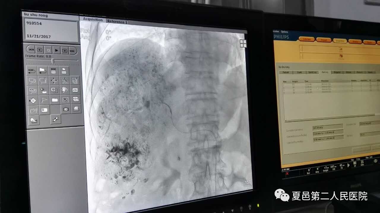 肝动脉造影栓塞术能治愈吗,肝动脉栓塞术治疗肝癌复发率高吗