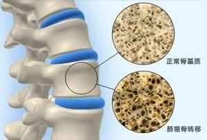 肺癌转移到骨头用唑来膦酸有用吗,肺癌转移骨头还咳血吃中药能好吗