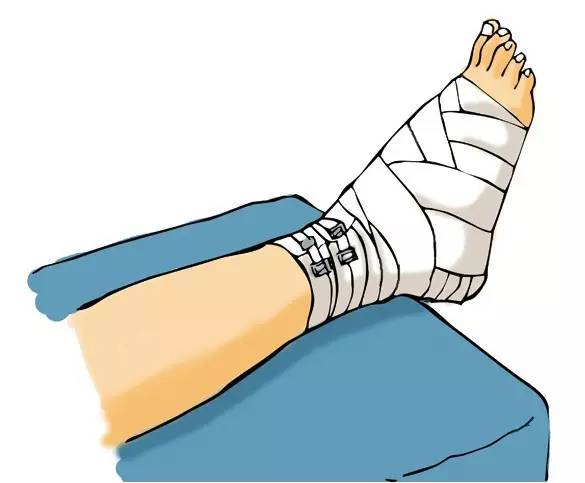 骨折卧床休息怎么个姿势,骨折了不能下地吗