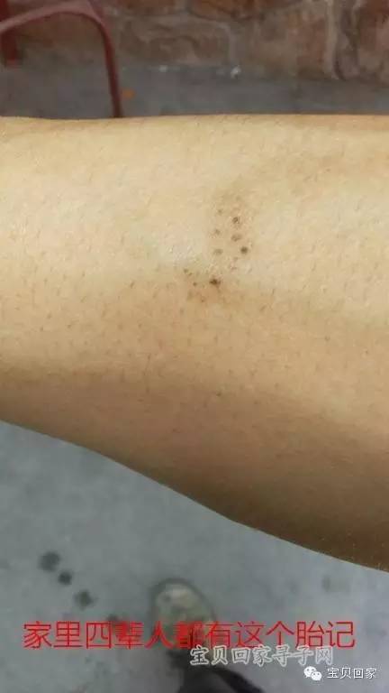 手臂上镌刻家族天然“烙印”的你,知道还有个姐姐在等你吗?