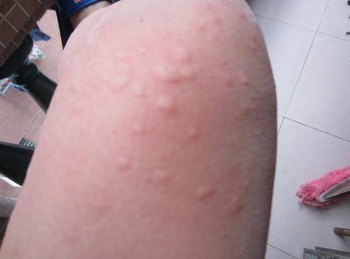 产后瘙痒症会自然好吗,产后下阴瘙痒可以用什么药