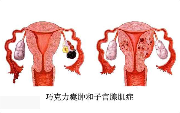 关于卵巢肿物——你必须关注的四大问题