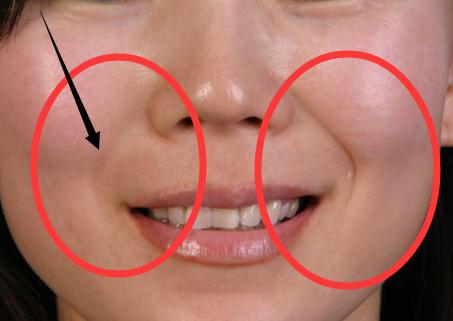 消除法令纹最有效的方法神器,消除法令纹有效而不痛的办法