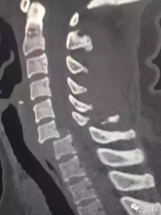 脊椎脱位是啥意思,脊椎脱位怎么牵引