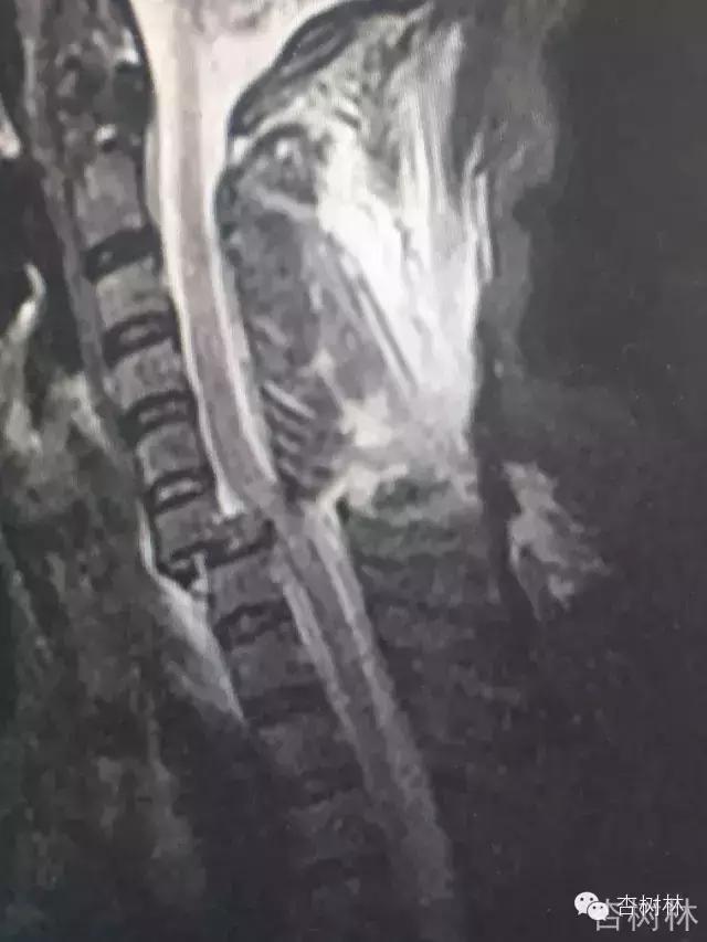 脊椎脱位是啥意思,脊椎脱位怎么牵引