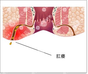 肛瘘中医诊断及鉴别,肛瘘如何诊断